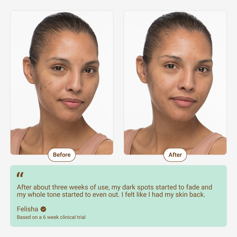  Before & after results from a clinical trial using brownkind's  Dark Spot Corrector