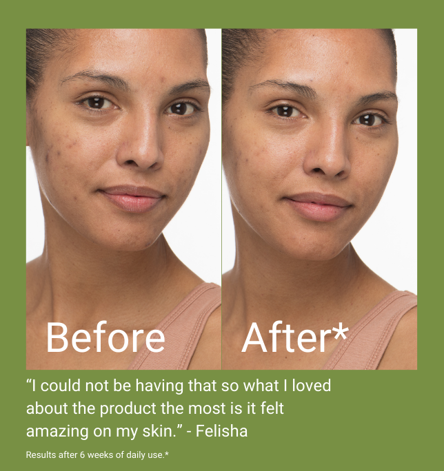 Before & after results from a clinical trial using brownkind's Dark Spot Corrector
